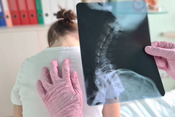 cele 4 semne vizibile care pot indica scolioza la copii afectiunea apare frecvent intre 10 si 15 ani 6a227560db273