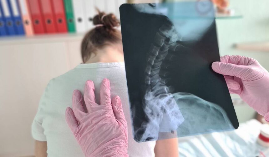 Cele patru semne care pot indica scolioza la copii între 10 și 15 ani 51 cele 4 semne vizibile care pot indica scolioza la copii afectiunea apare frecvent intre 10 si 15 ani 6a227560db273