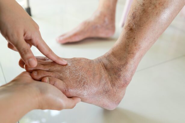 picioare umflate urina spumoasa si oboseala persistenta semne care pot indica probleme renale la persoanele cu diabet sau hipertensiune 6a37a97dc8b54