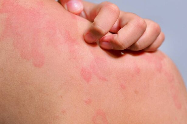 urticaria cronica spontana cat dureaza de ce apare si cand trebuie sa mergi la medic 6a2ea73e54f57