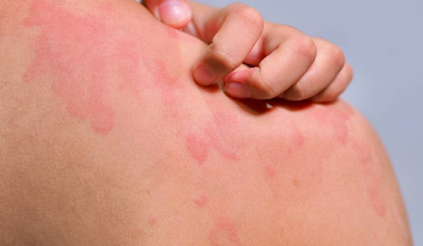 Urticaria cronică spontană: cauze, durată și momentul potrivit pentru a consulta un medic 51 urticaria cronica spontana cat dureaza de ce apare si cand trebuie sa mergi la medic 6a2ea73e54f57