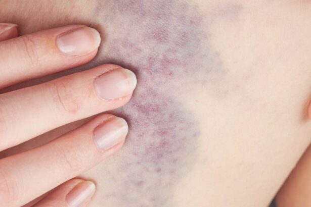afectiunea grava care se ascunde in spatele oboselii si vanatailor care apar usor 6a44b403c15eb