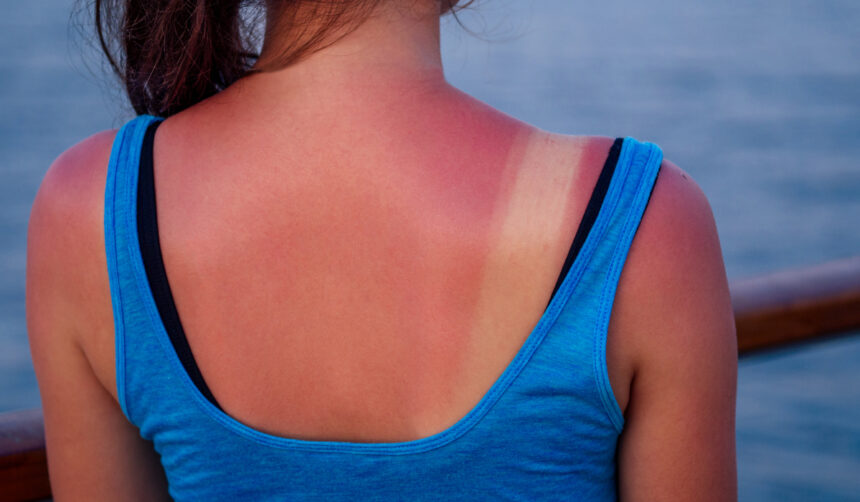 Arsurile solare pot fi periculoase. Cinci episoade cresc riscul de cancer de piele 51 arsurile solare nu sunt inofensive cinci episoade pot creste semnificativ riscul de cancer de piele 6a51f945e4bce
